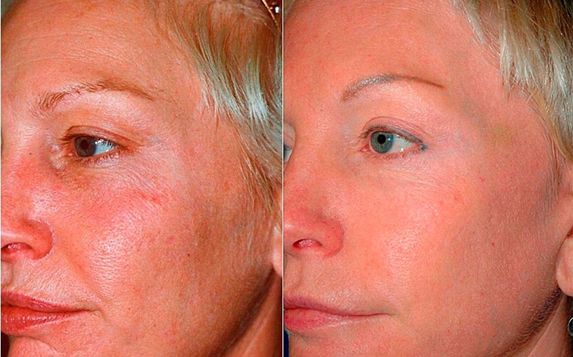 Пример фото до и после после курса химического пилинга лица
